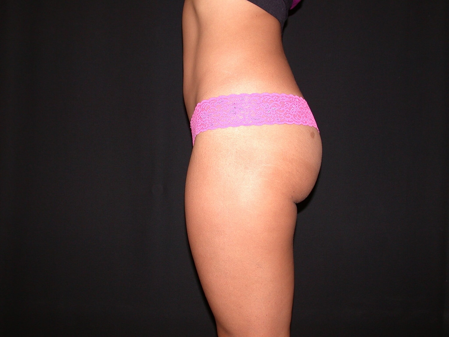 Liposuction Before & After