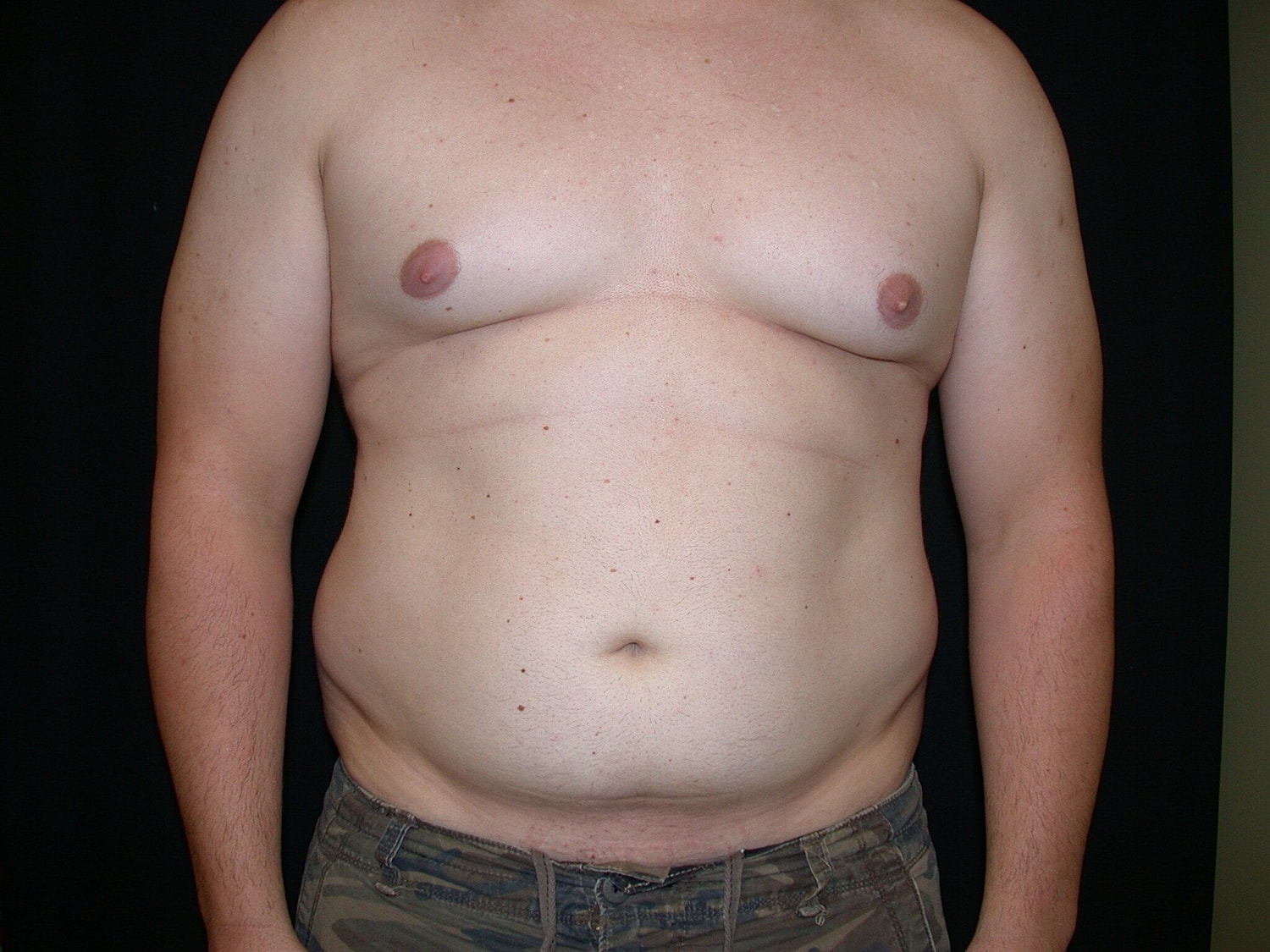 Liposuction Before & After