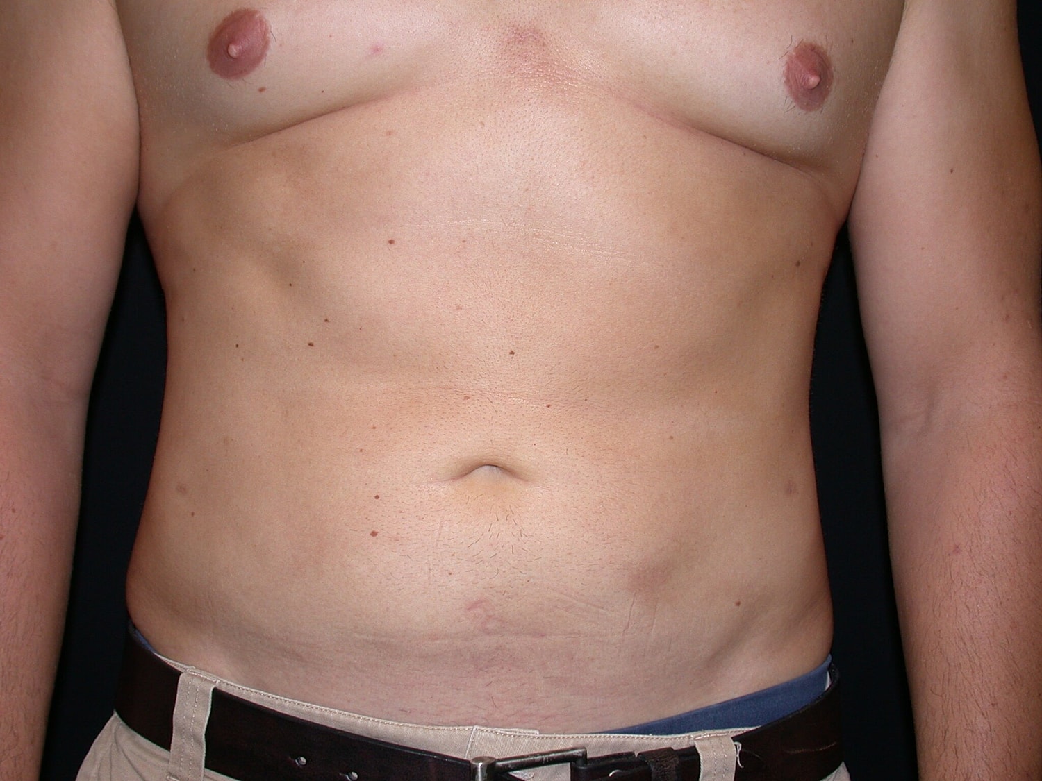 Liposuction Before & After