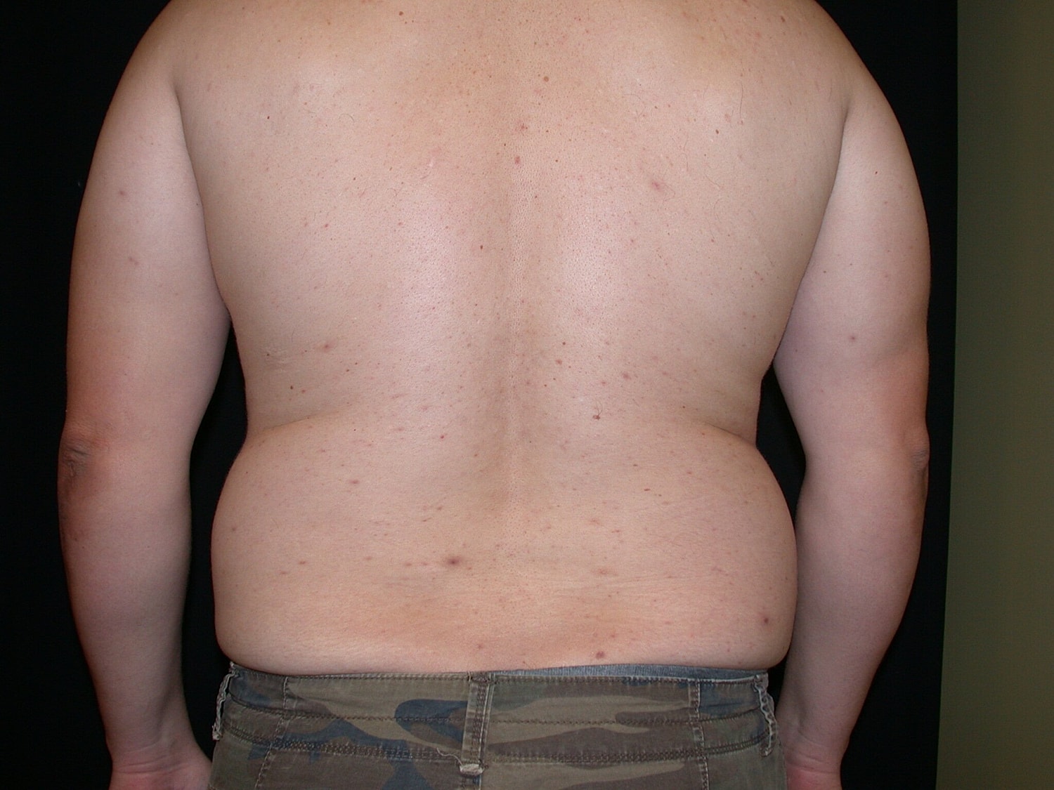Liposuction Before & After