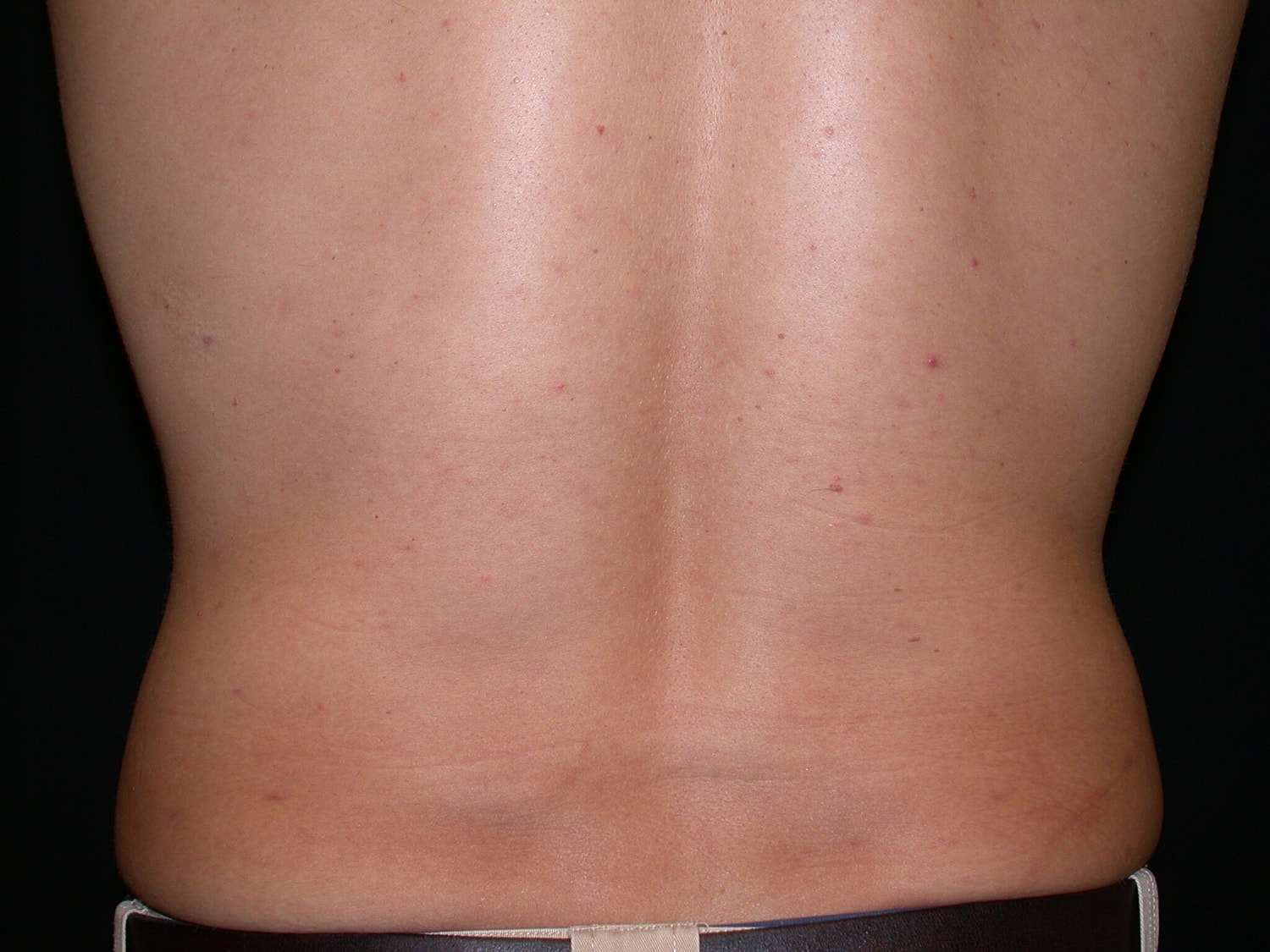 Liposuction Before & After