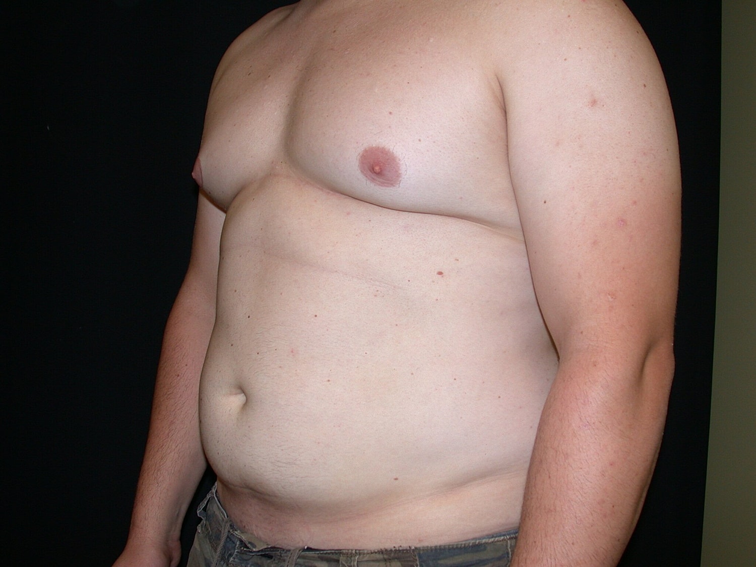 Liposuction Before & After