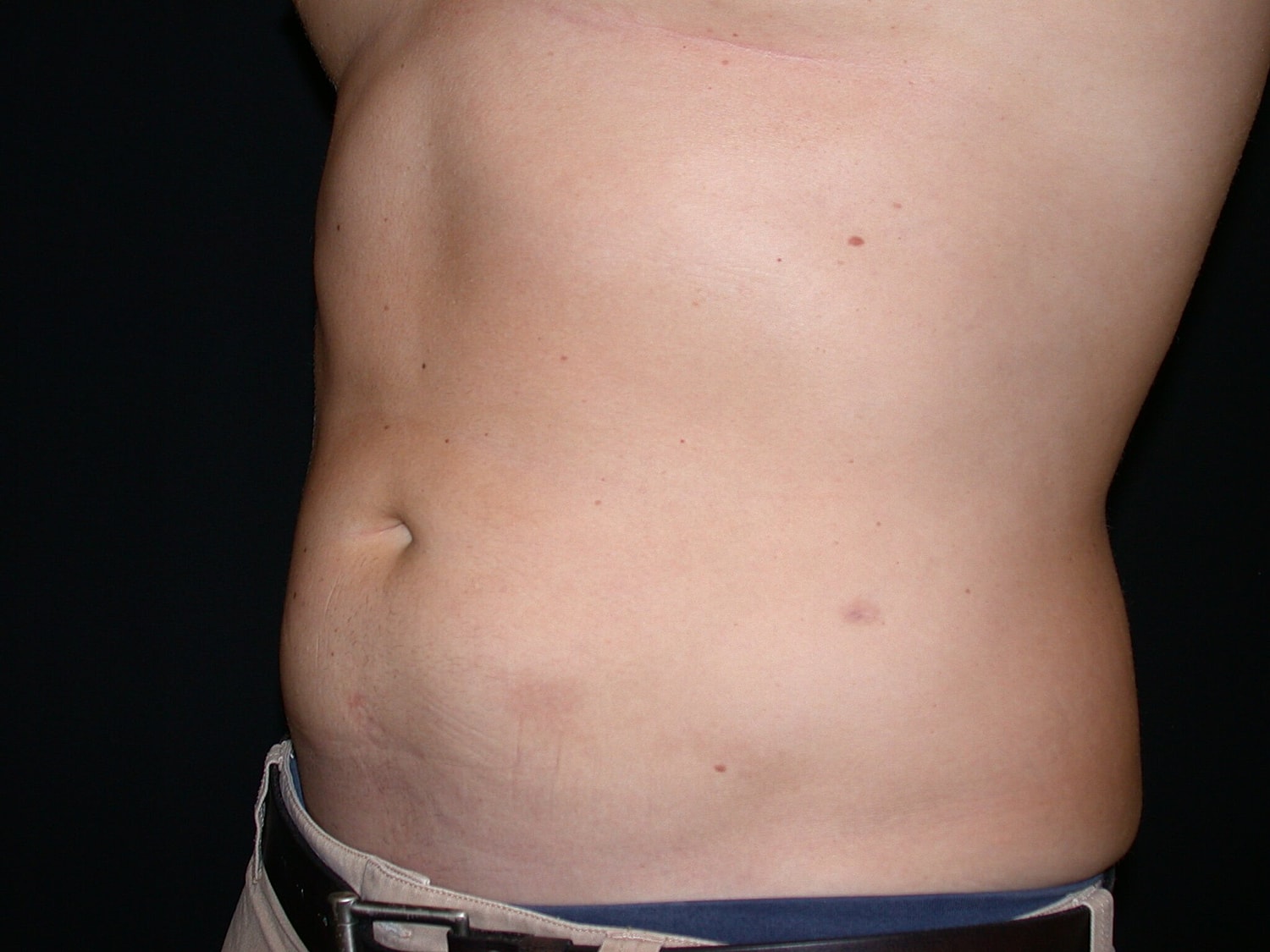 Liposuction Before & After