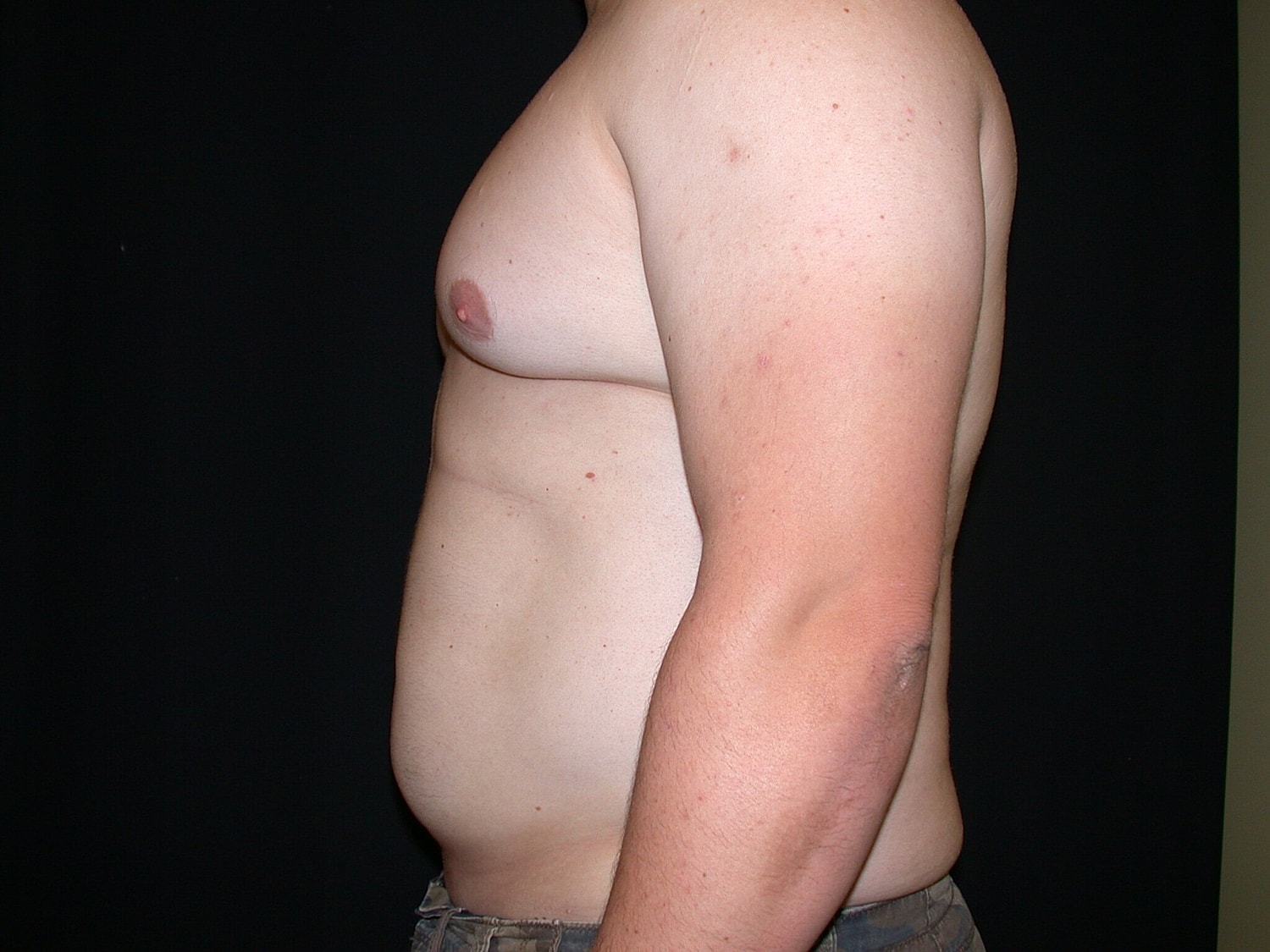 Liposuction Before & After