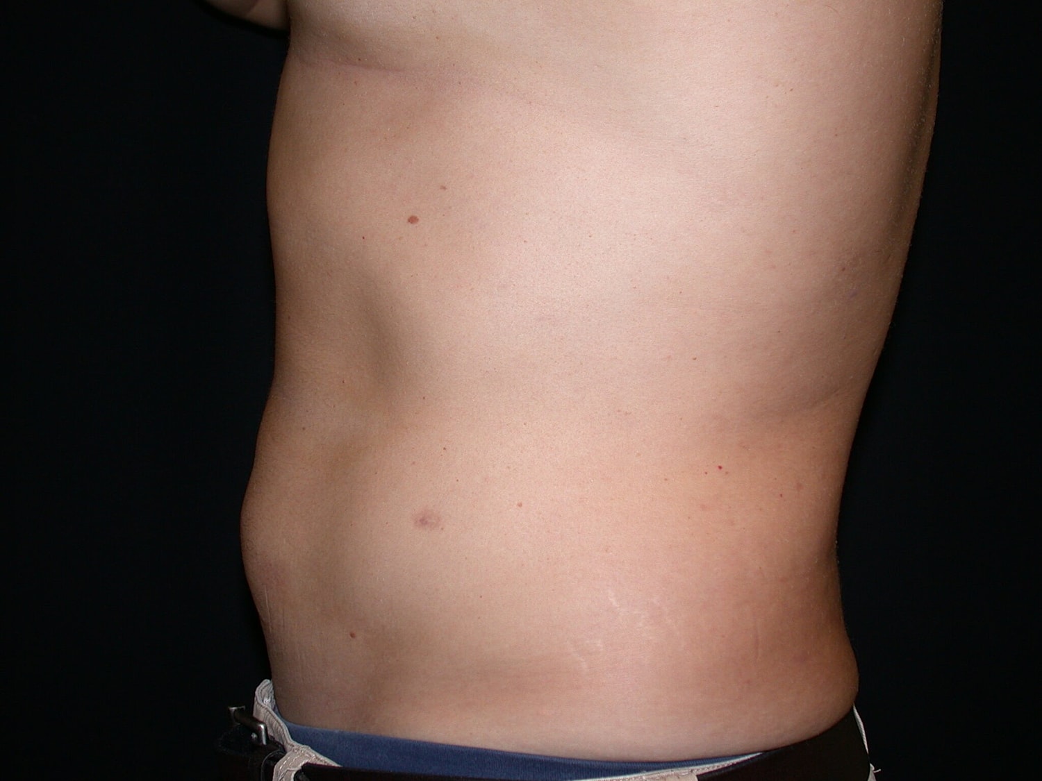 Liposuction Before & After
