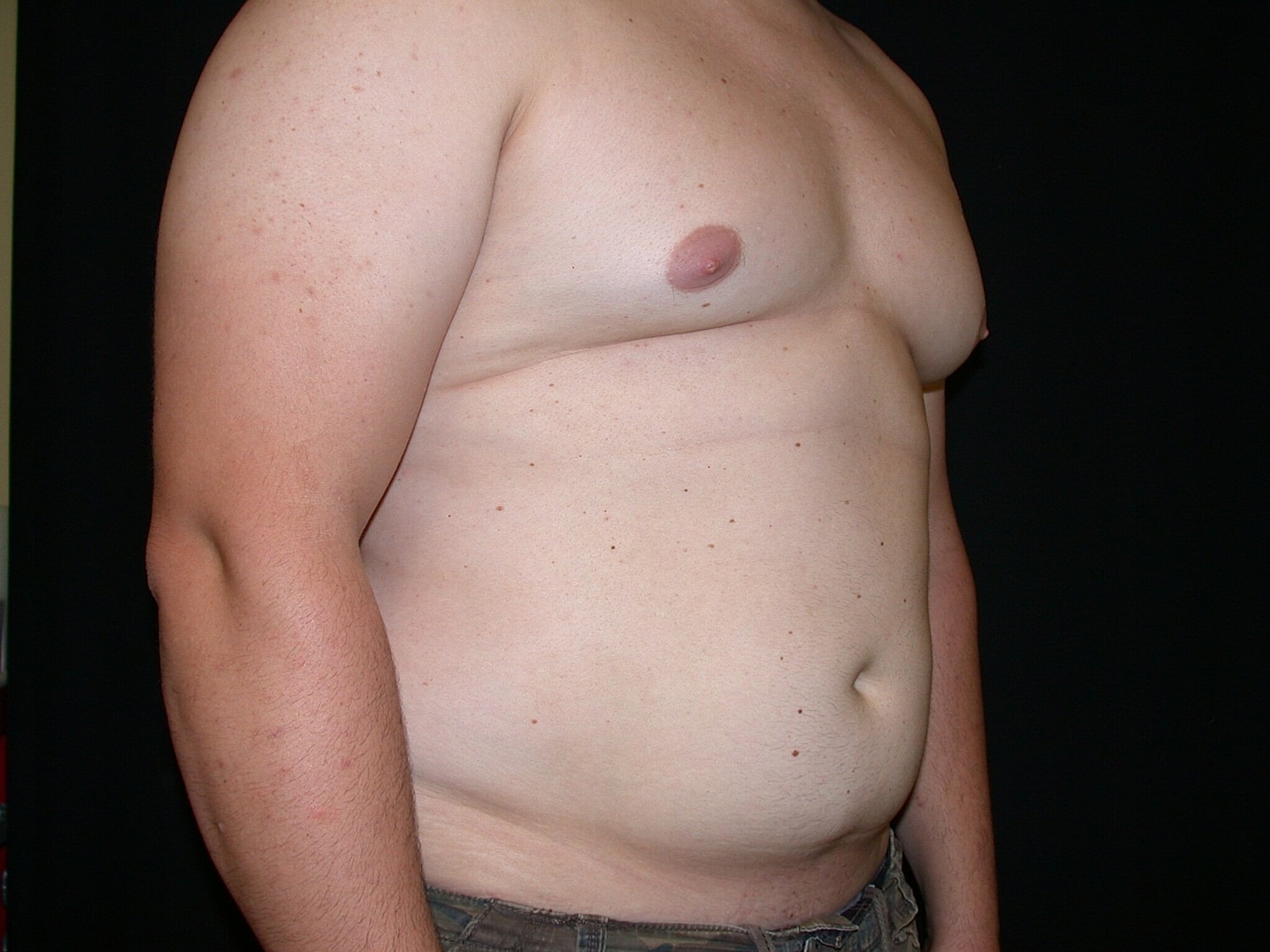 Liposuction Before & After