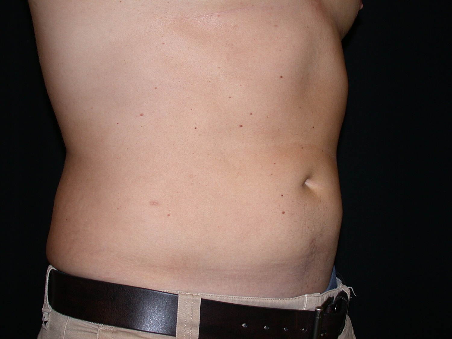 Liposuction Before & After