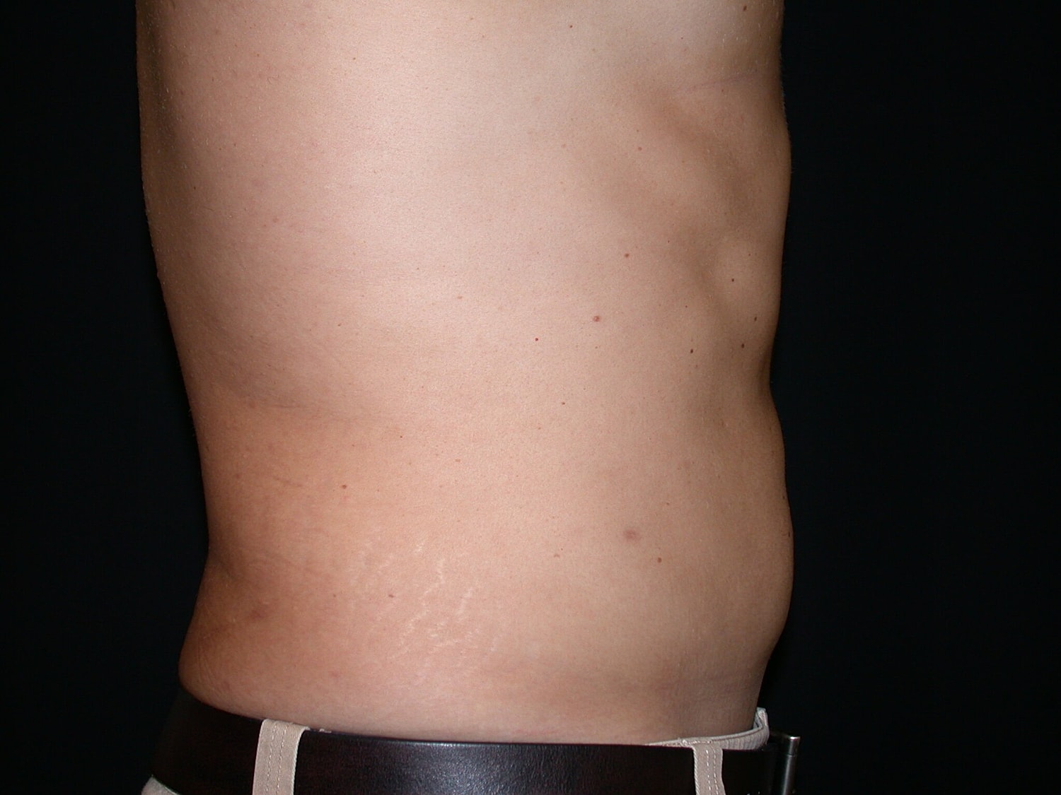 Liposuction Before & After