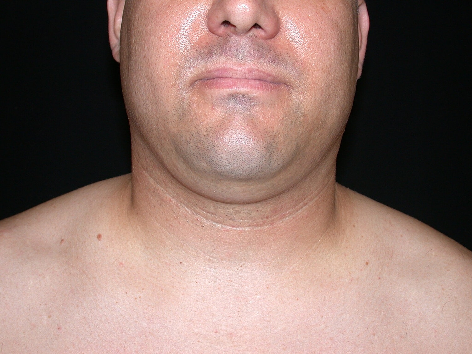 Liposuction Before & After