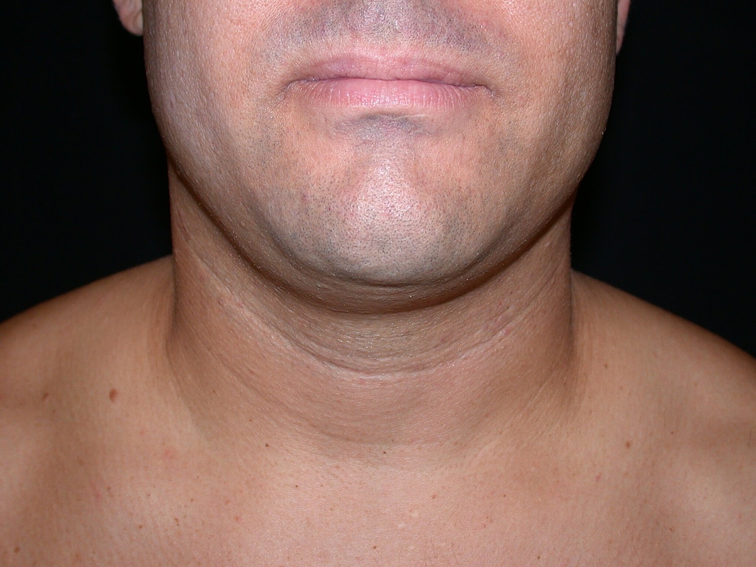 Liposuction Before & After