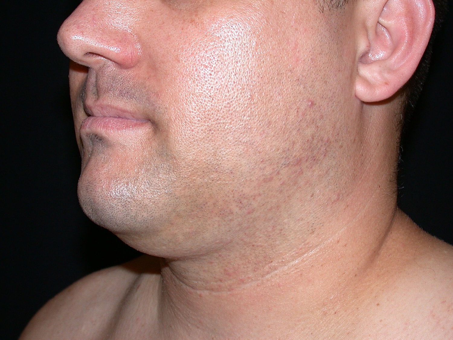 Liposuction Before & After