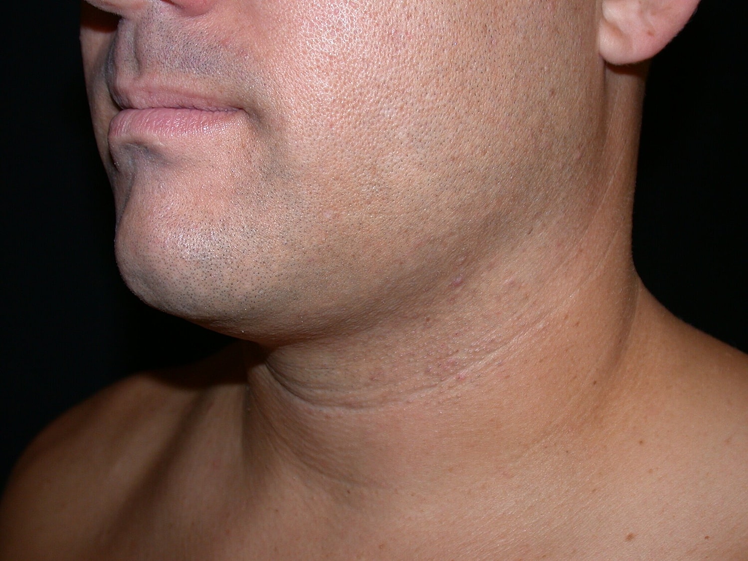 Liposuction Before & After