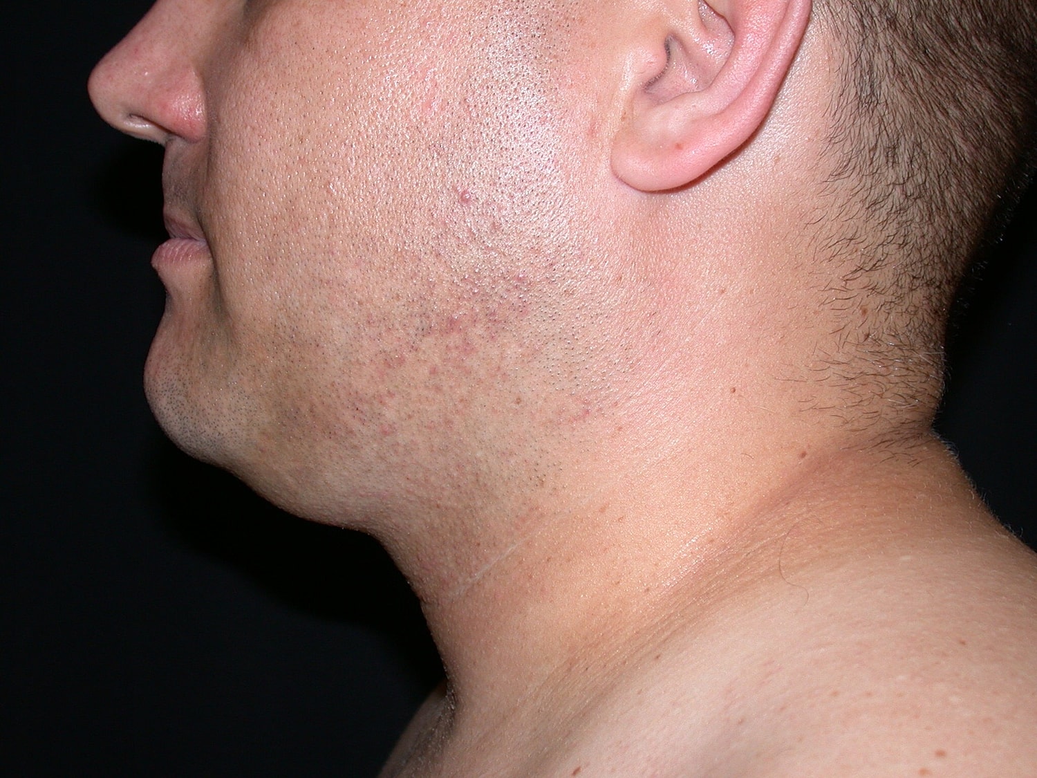 Liposuction Before & After