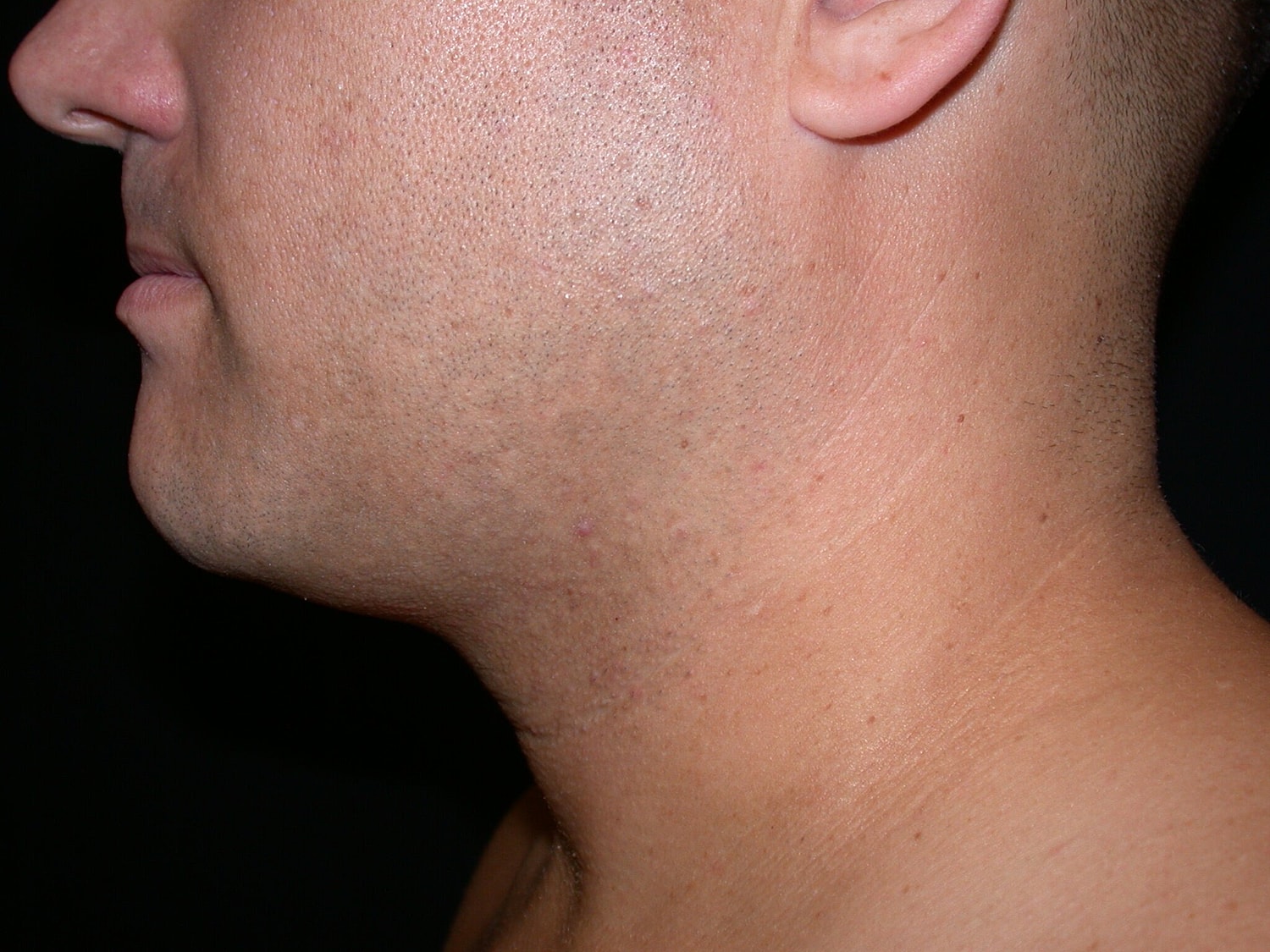 Liposuction Before & After