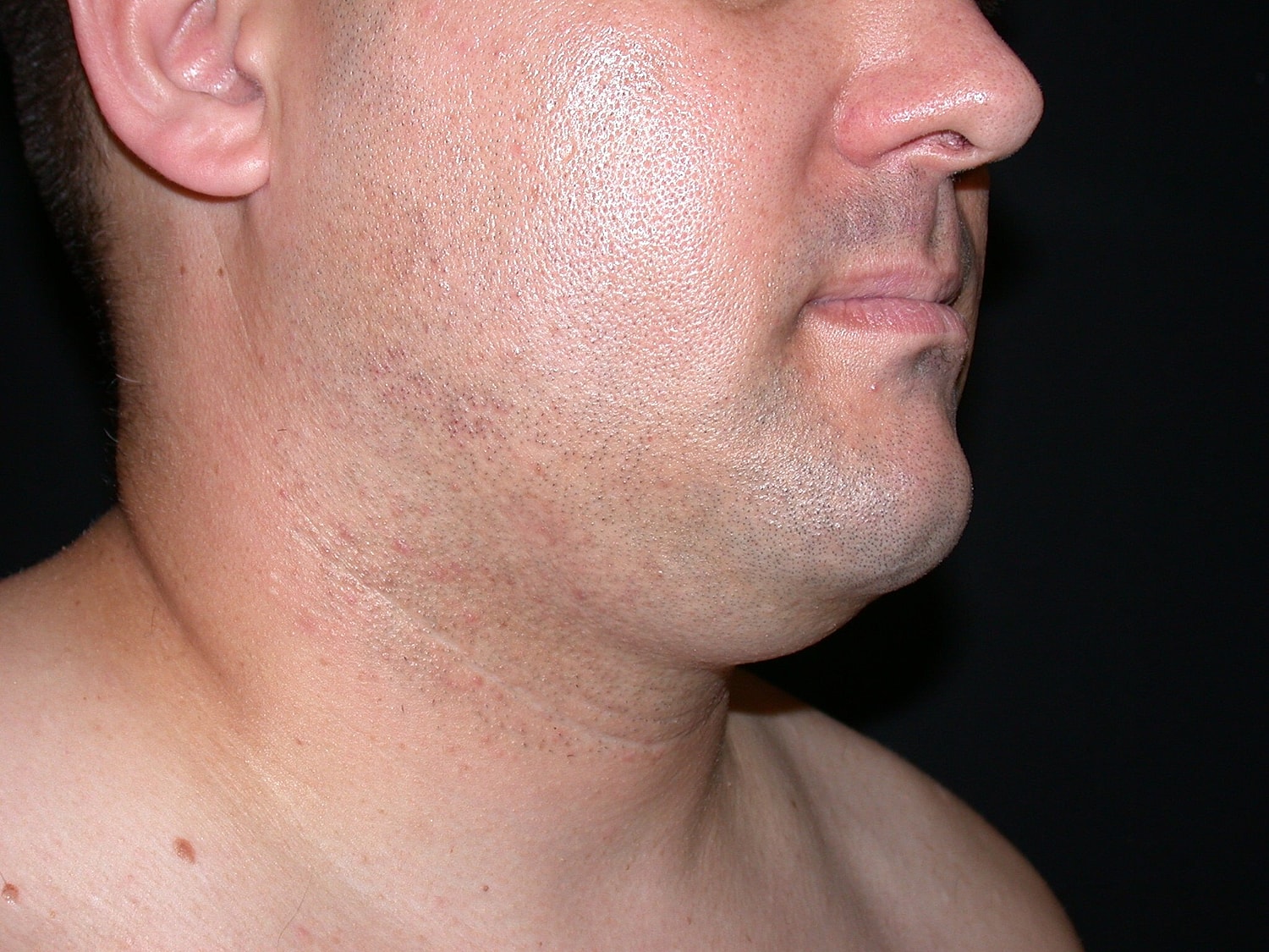 Liposuction Before & After