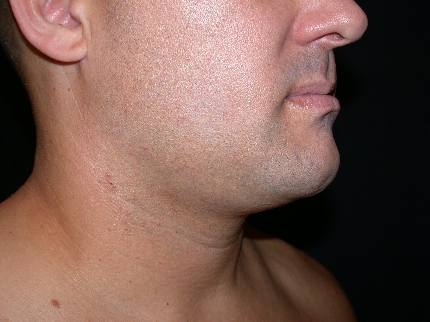 Liposuction Before & After