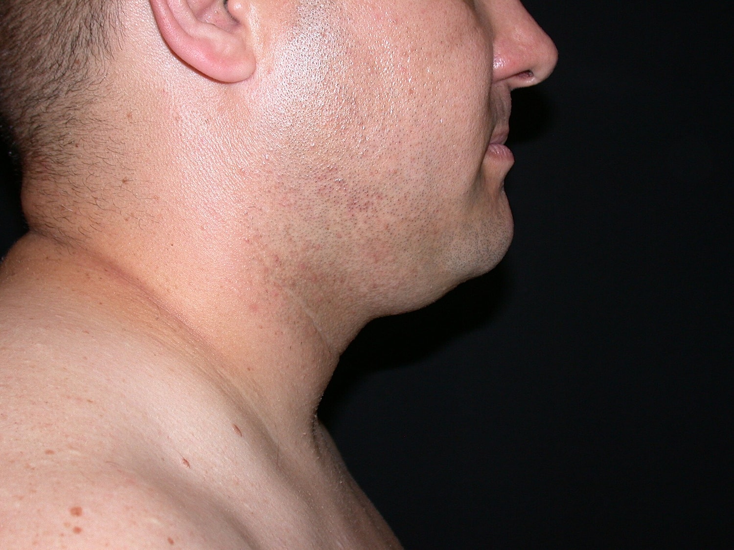 Liposuction Before & After