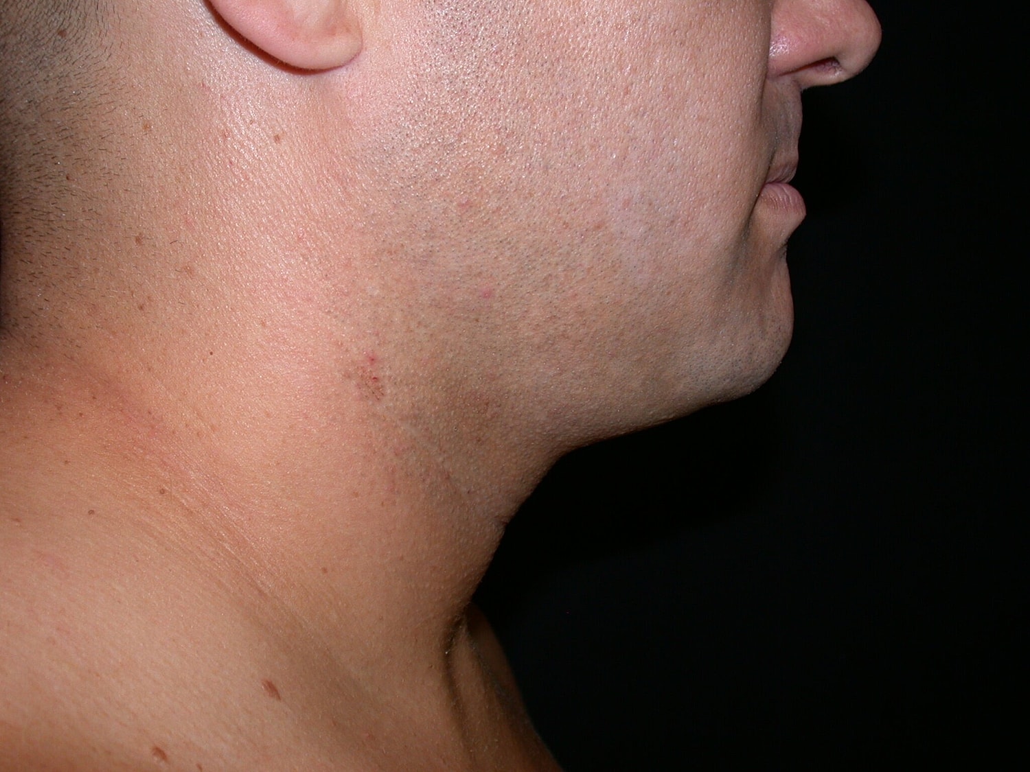 Liposuction Before & After