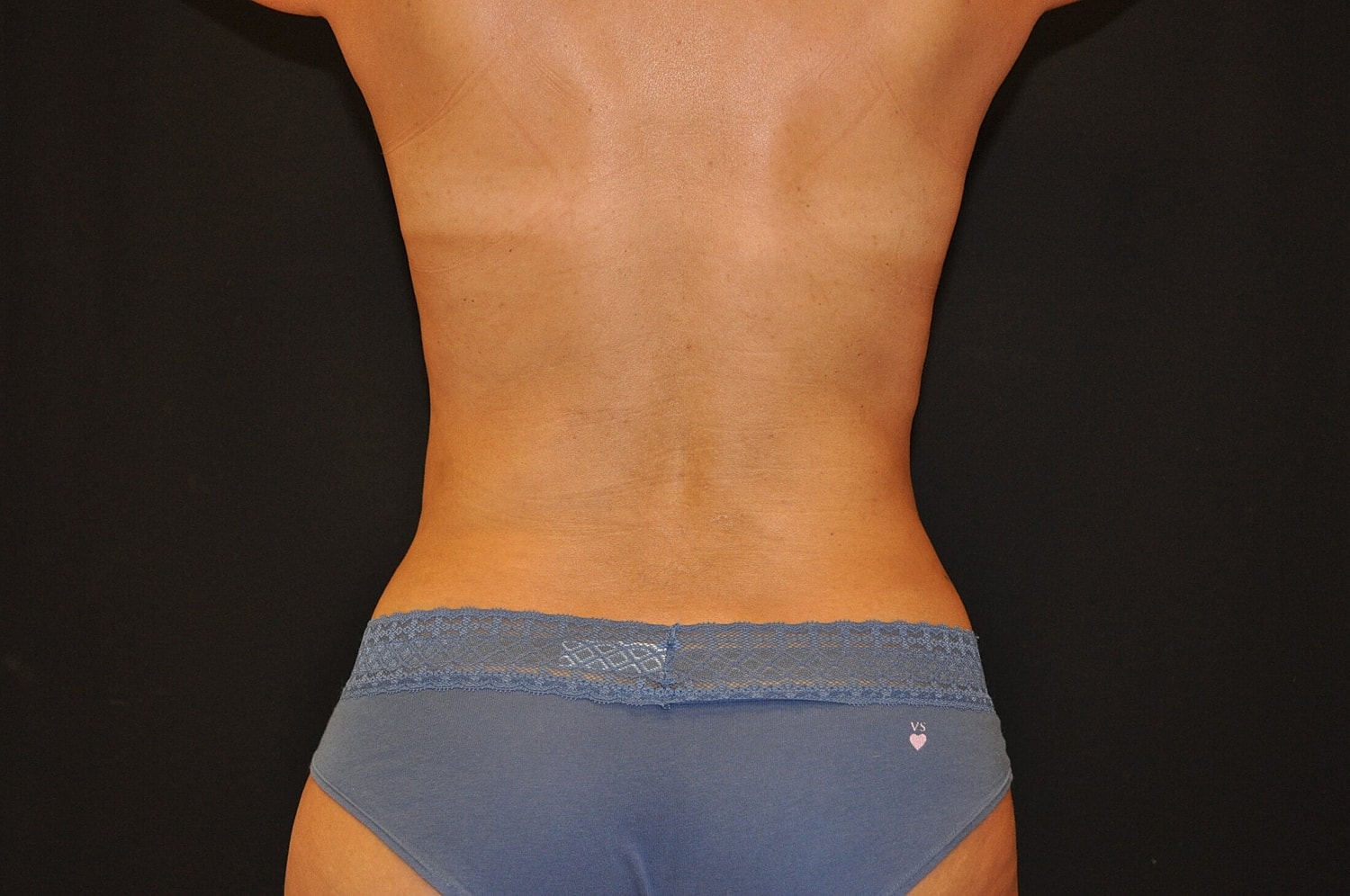 Liposuction Before & After