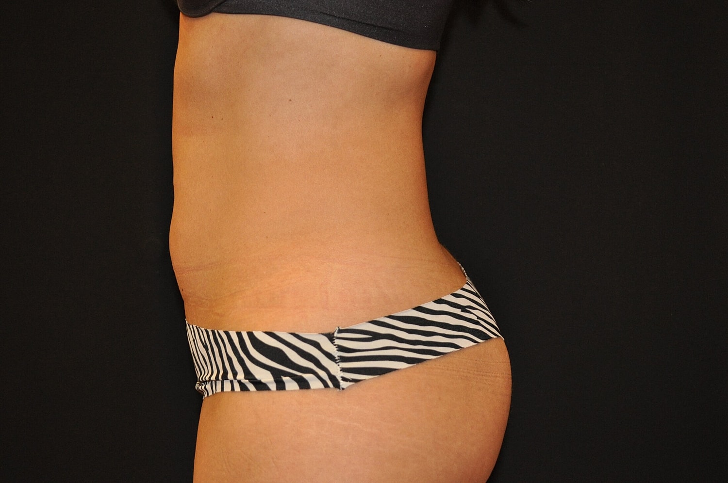 Liposuction Before & After