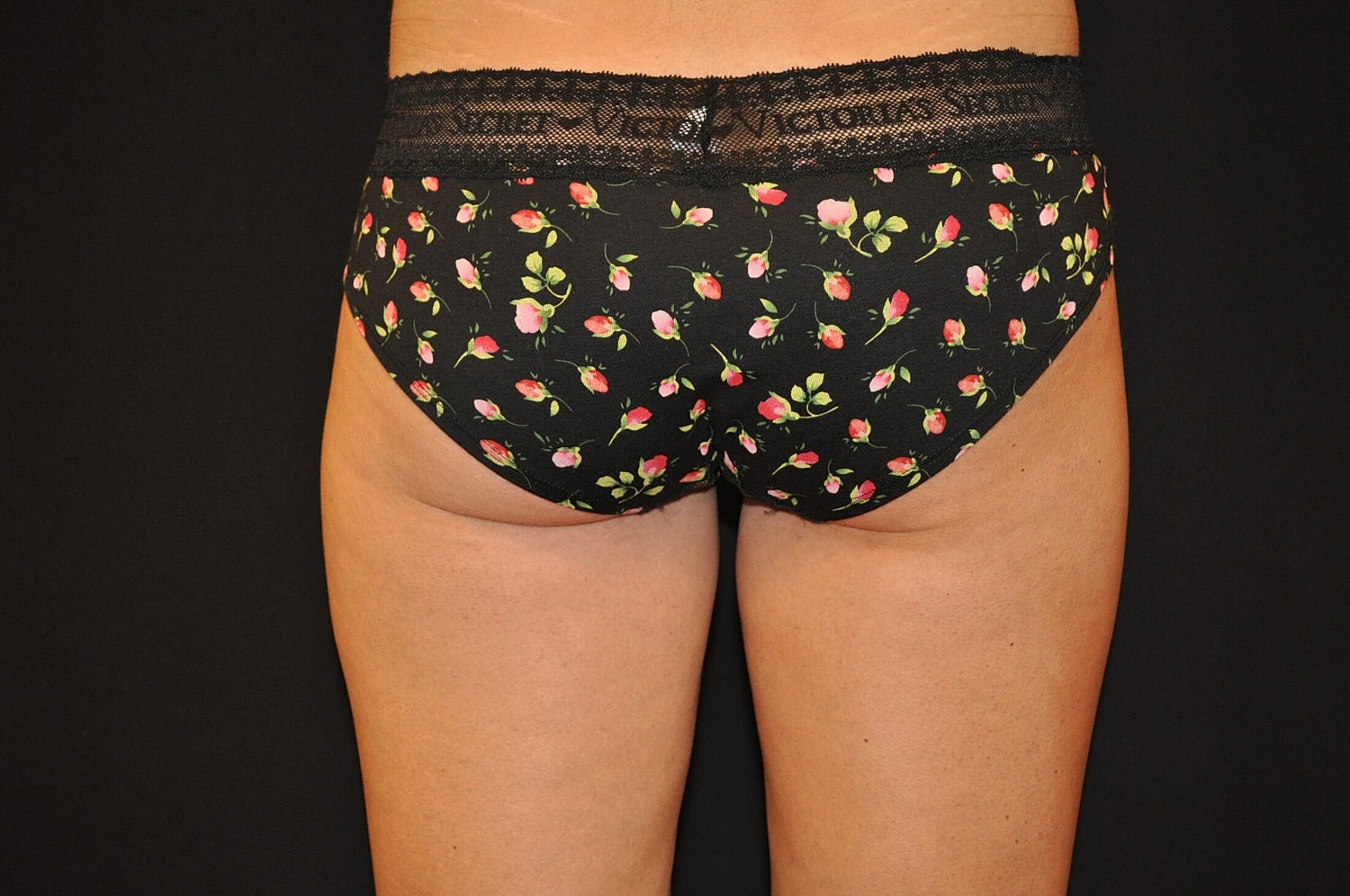 Liposuction Before & After