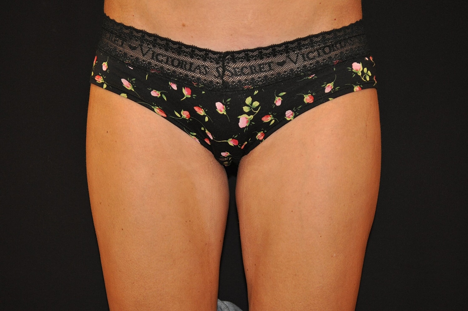 Liposuction Before & After