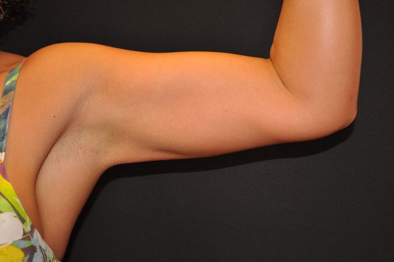 Liposuction Before & After