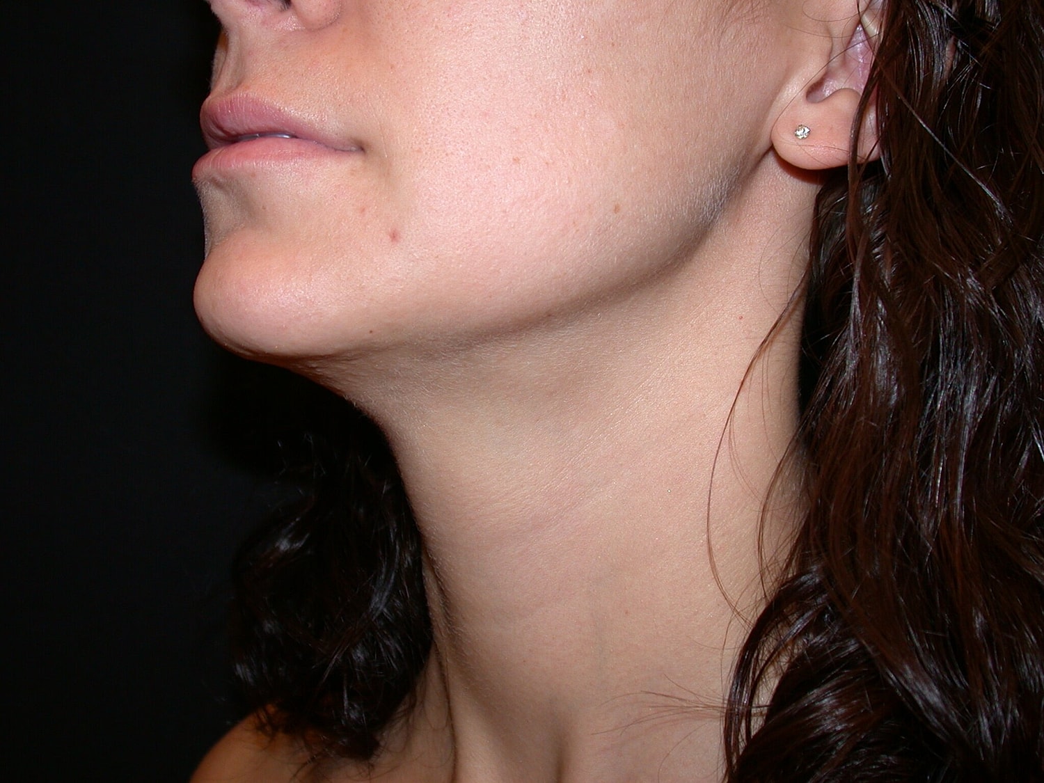 Liposuction Before & After