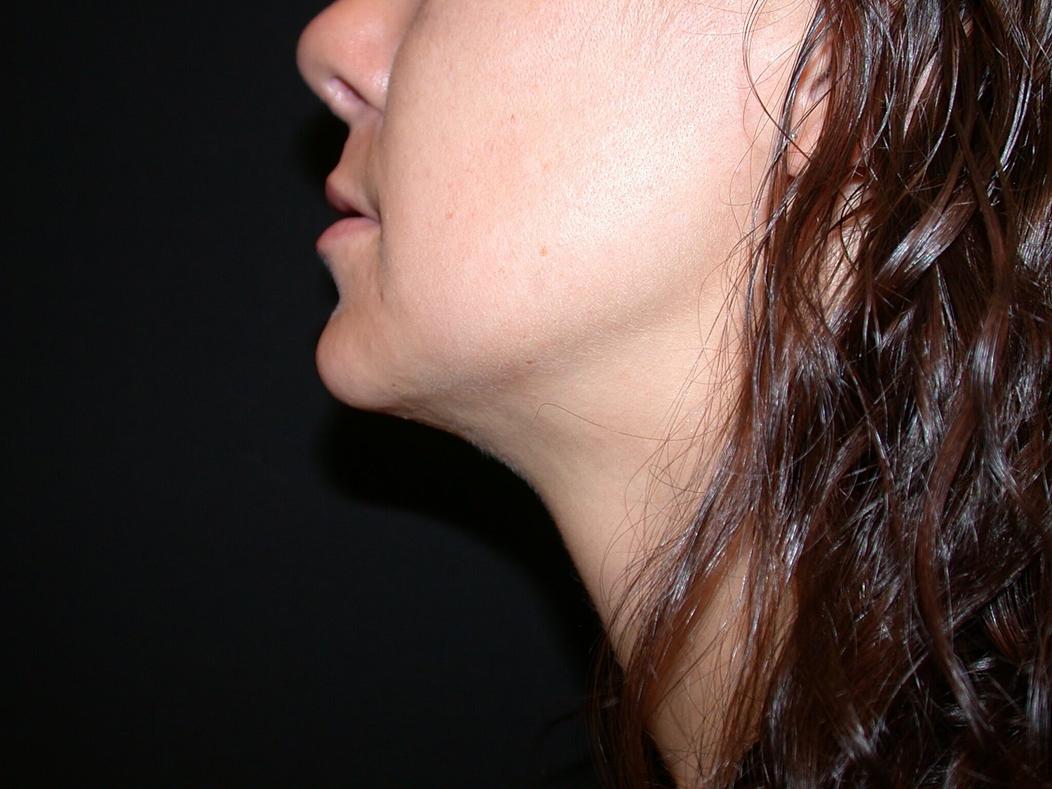 Liposuction Before & After