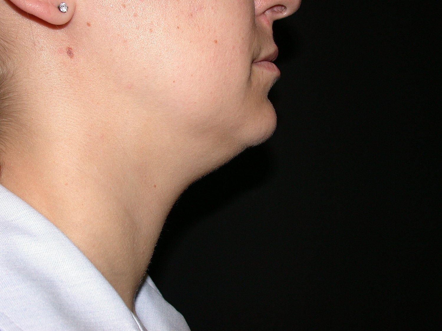 Liposuction Before & After