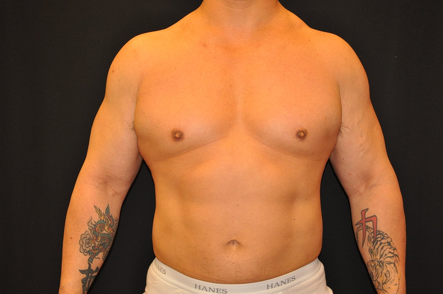 Liposuction Before & After