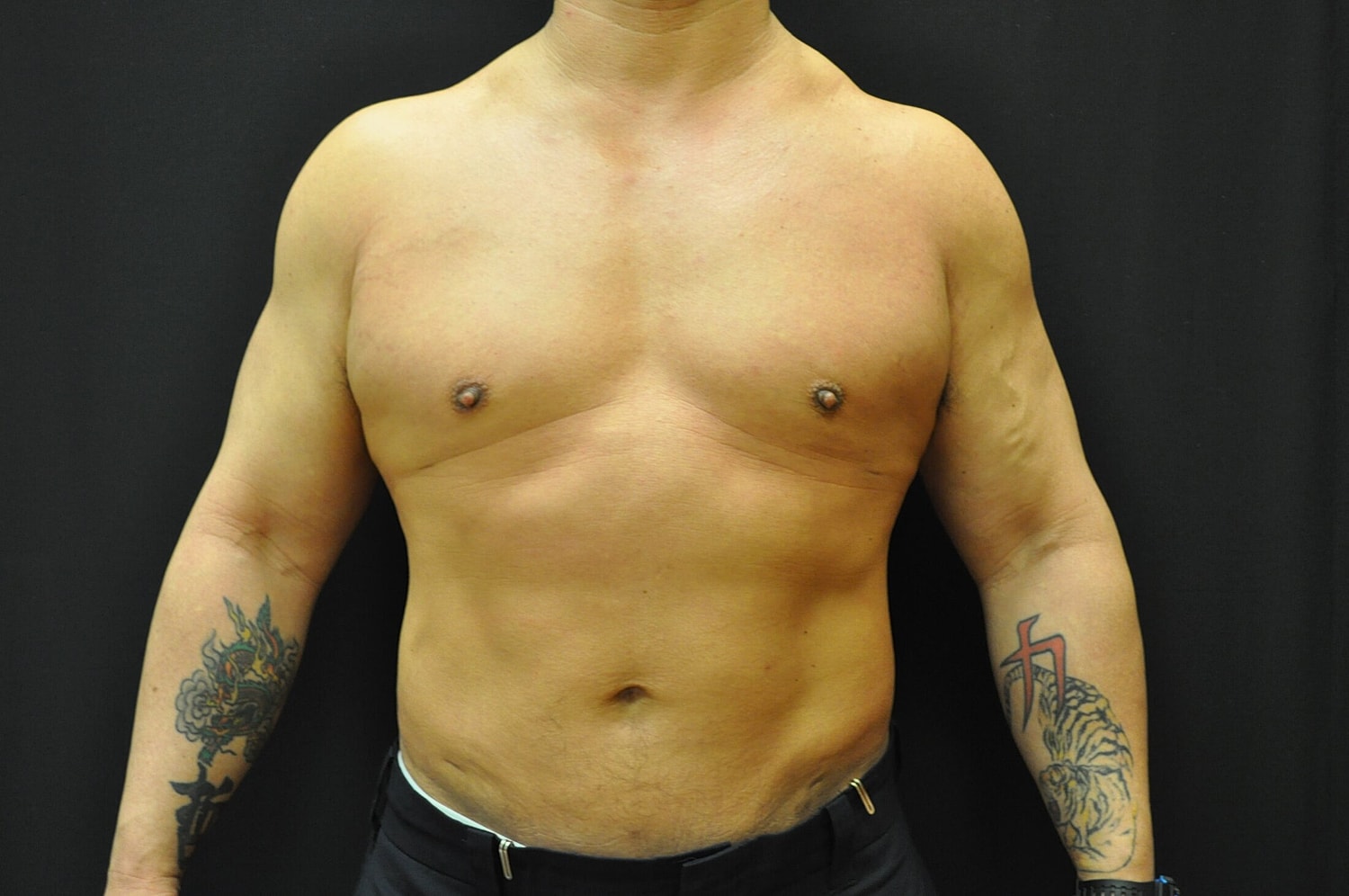 Liposuction Before & After