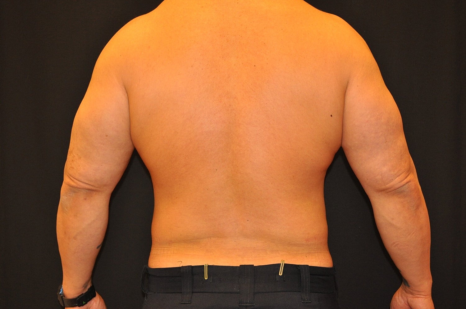 Liposuction Before & After