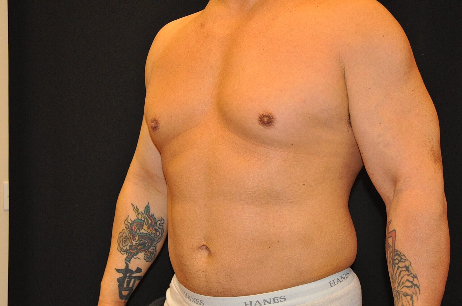 Liposuction Before & After