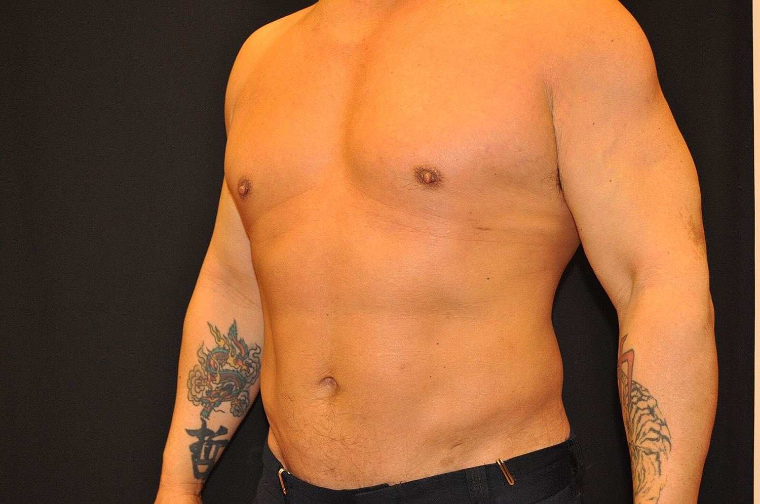 Liposuction Before & After