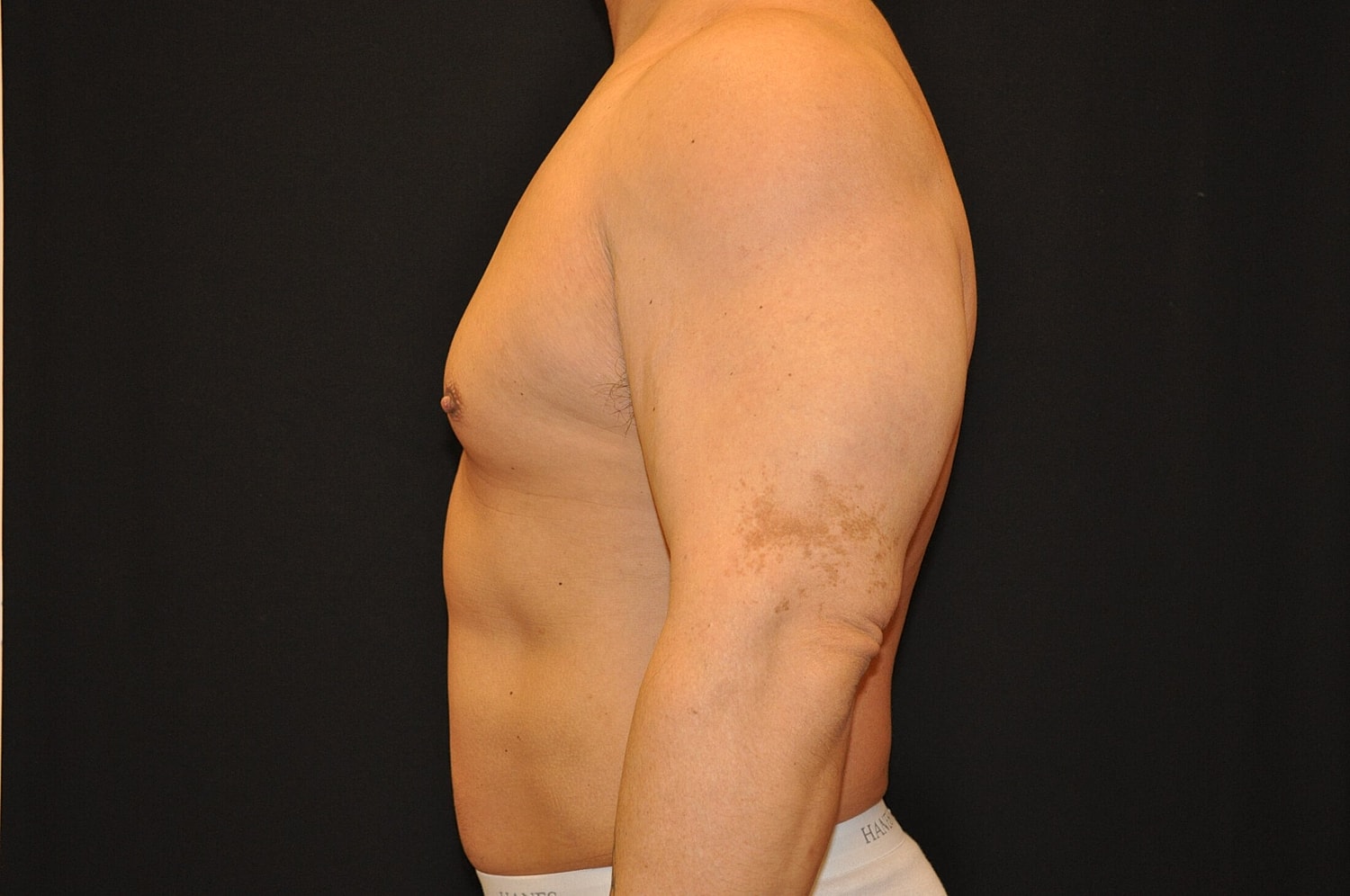 Liposuction Before & After