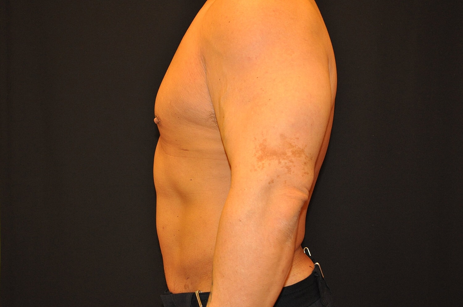 Liposuction Before & After