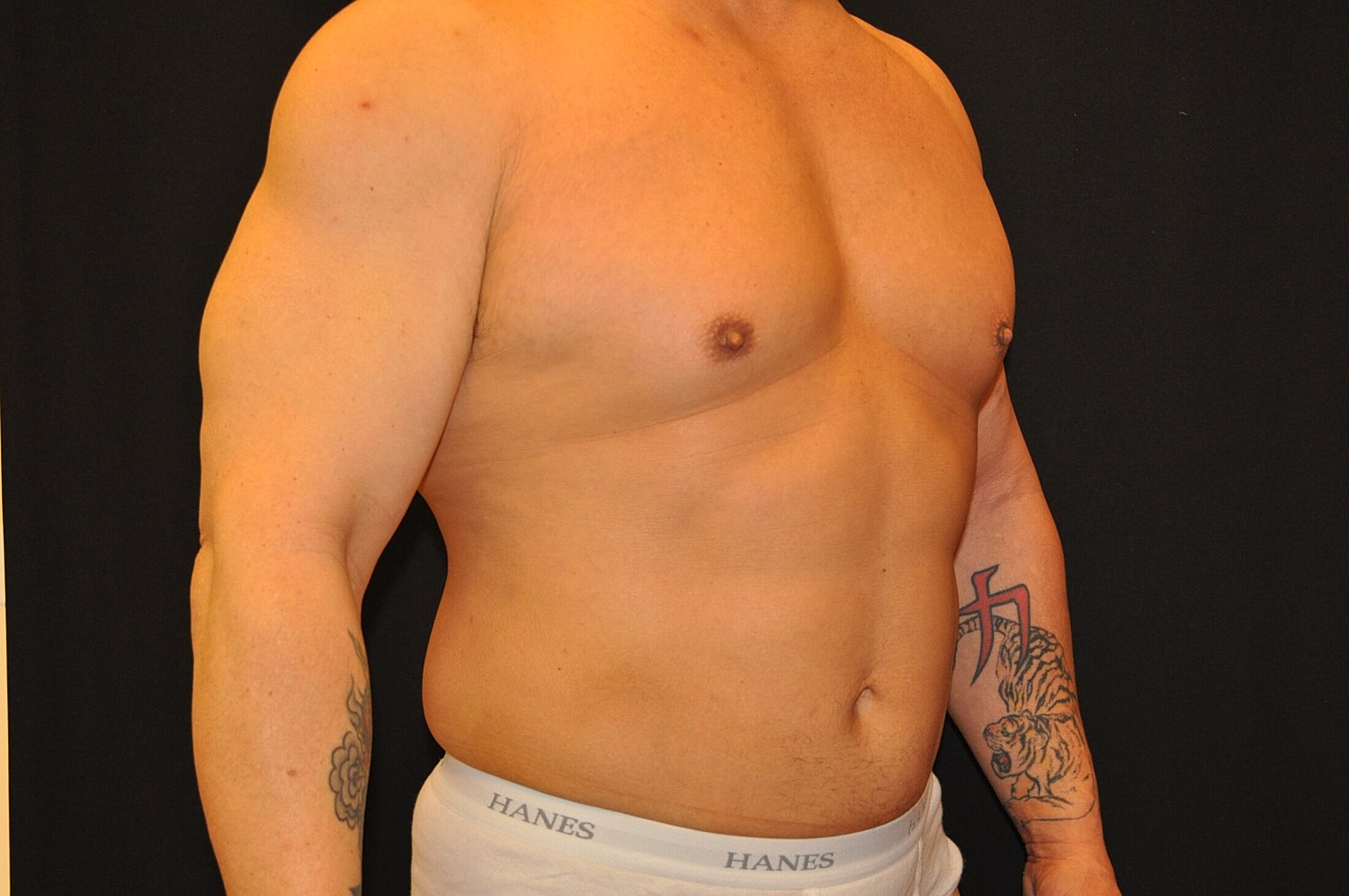 Liposuction Before & After