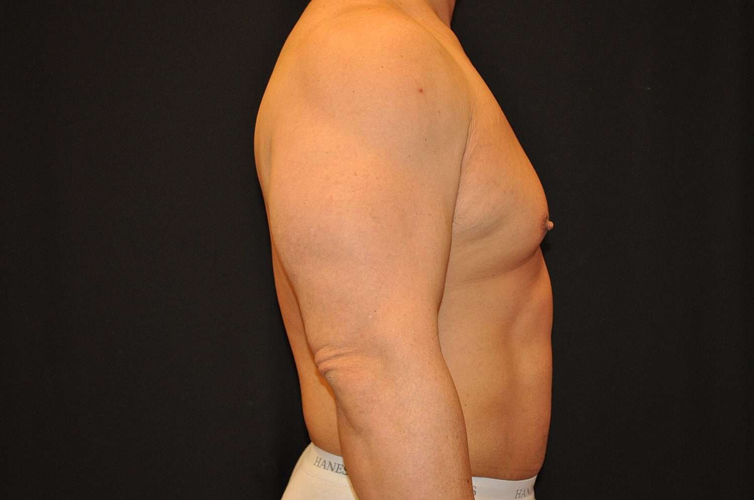 Liposuction Before & After