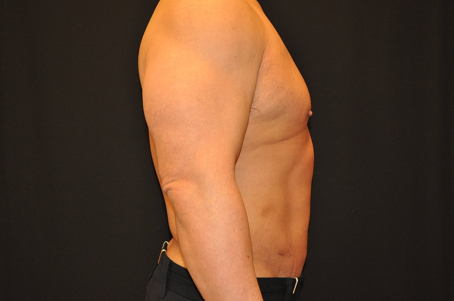 Liposuction Before & After