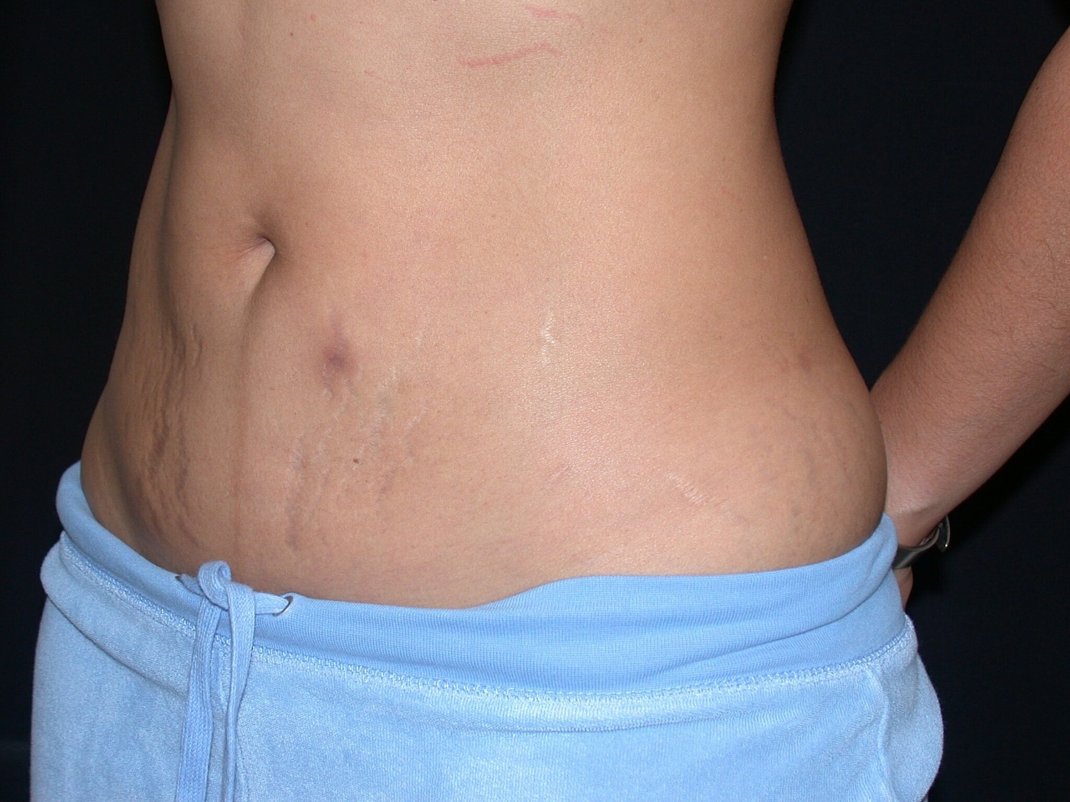 Liposuction Before & After