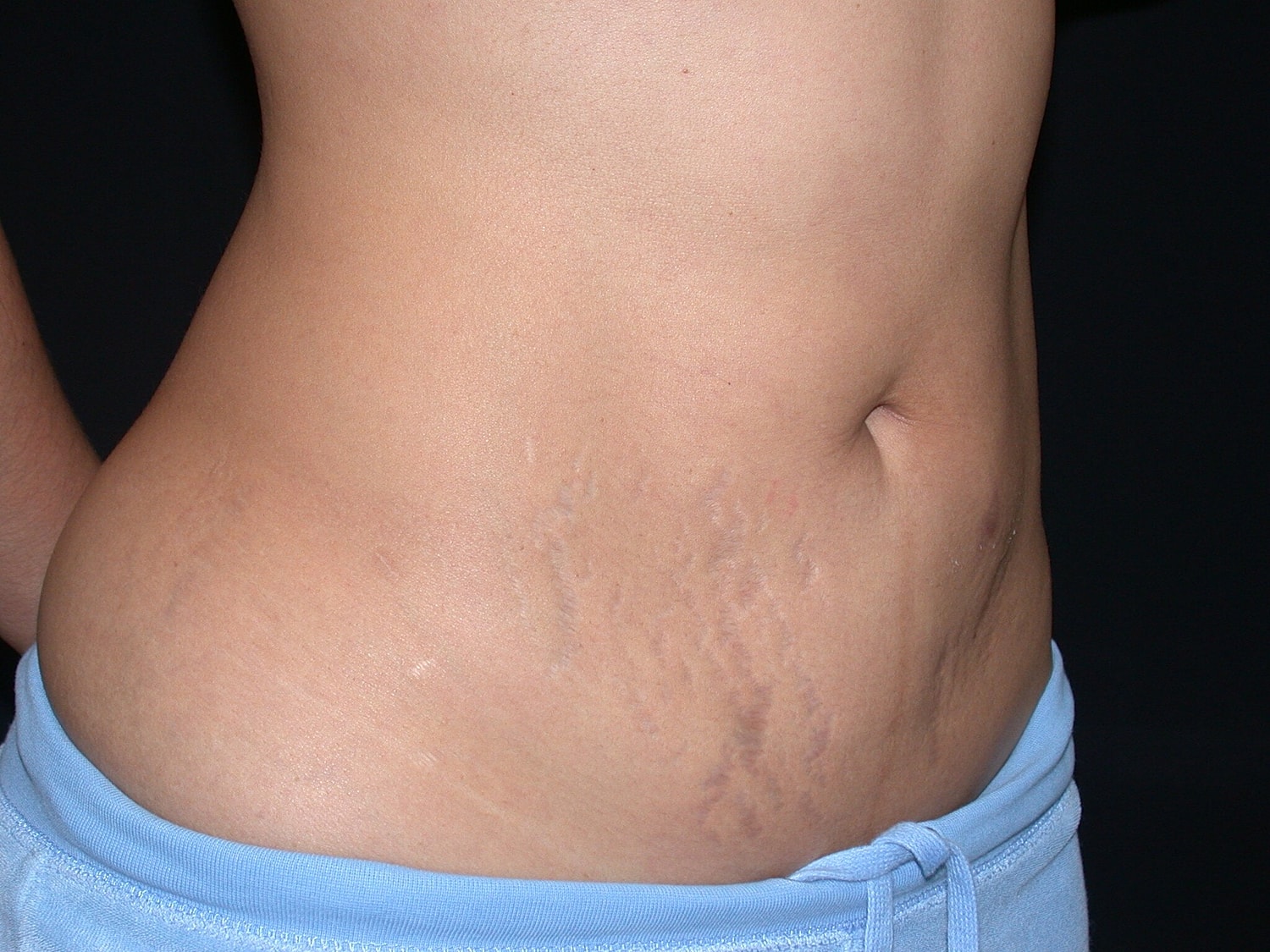 Liposuction Before & After