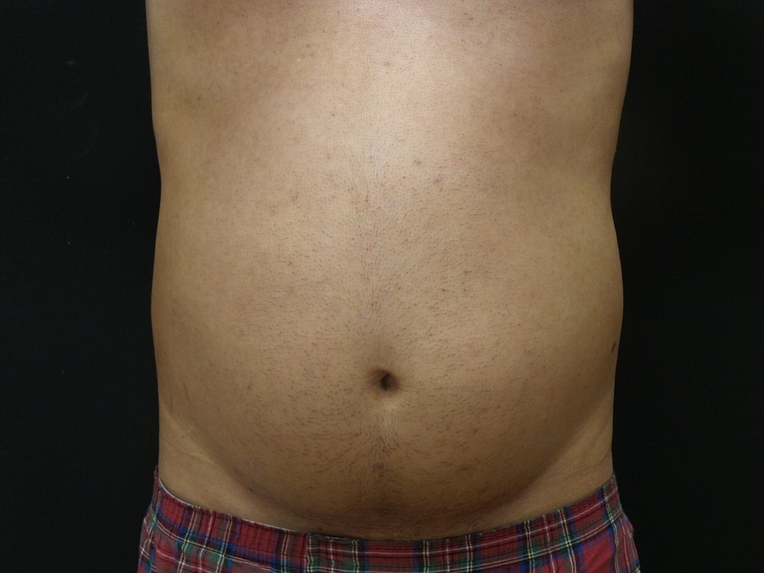 Liposuction Before & After