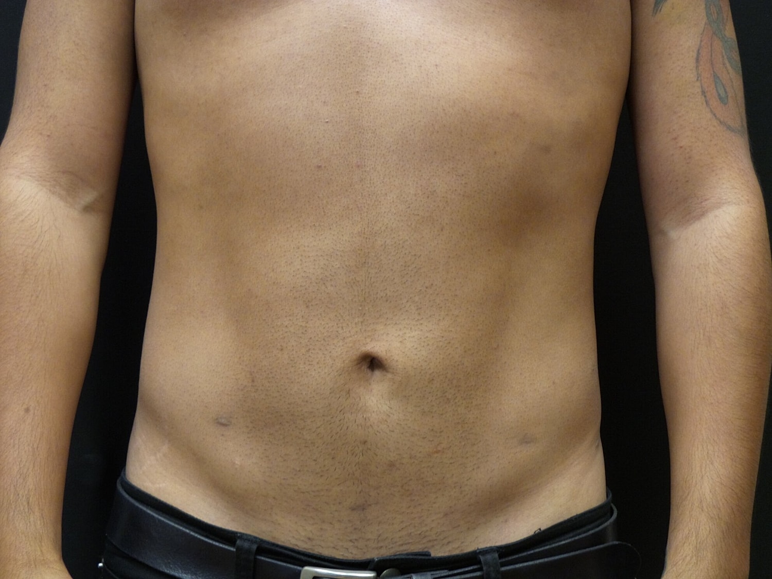 Liposuction Before & After