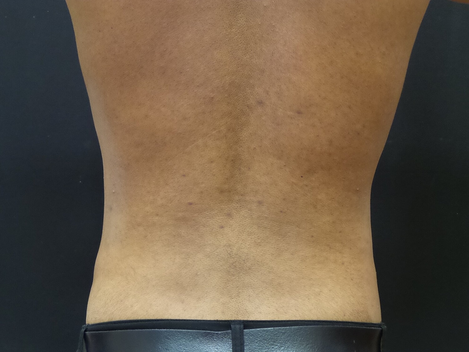 Liposuction Before & After