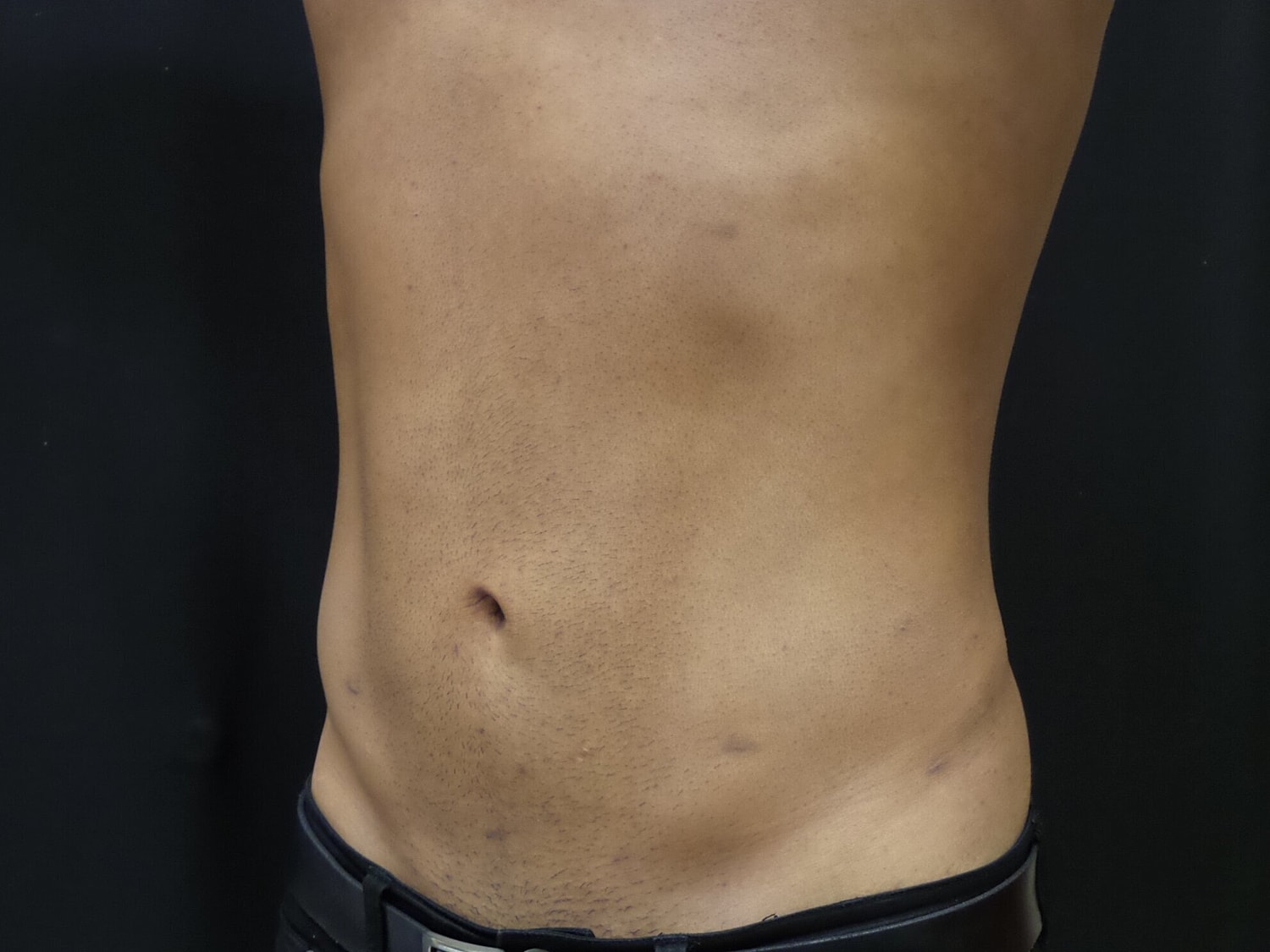 Liposuction Before & After