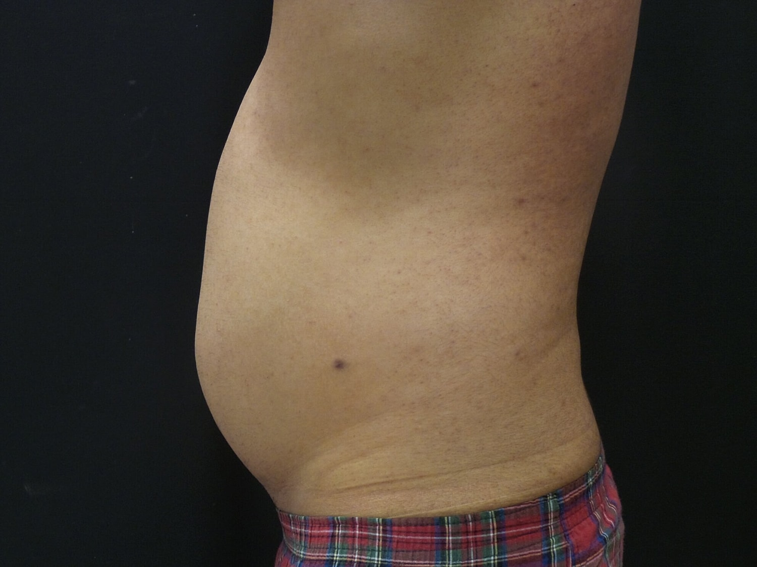 Liposuction Before & After