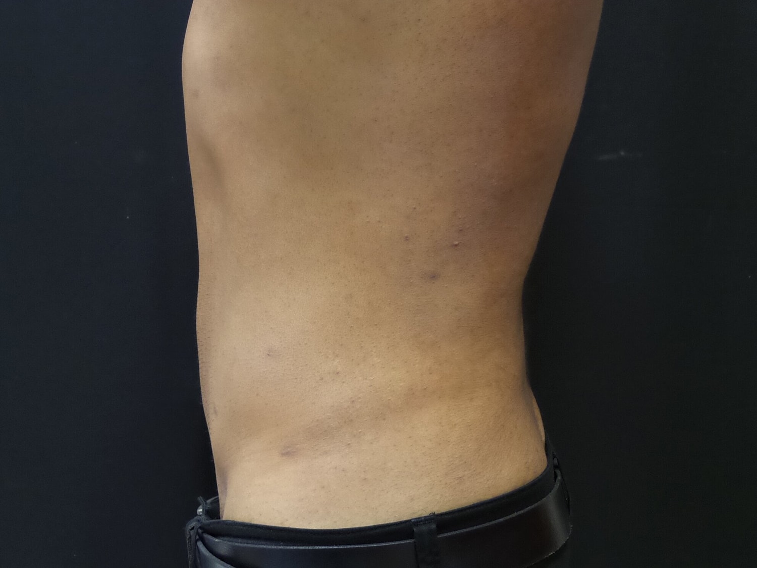 Liposuction Before & After