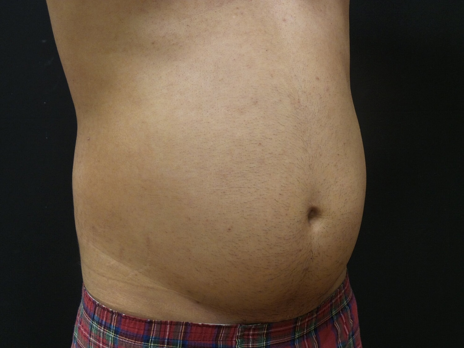 Liposuction Before & After