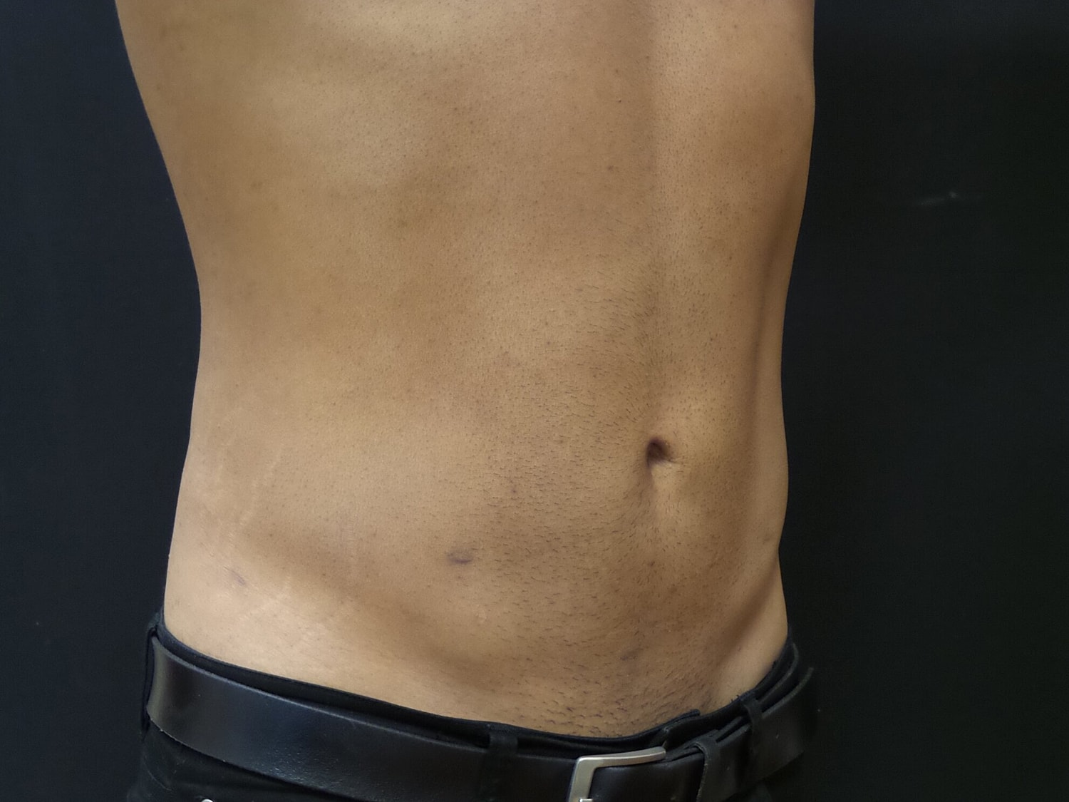 Liposuction Before & After